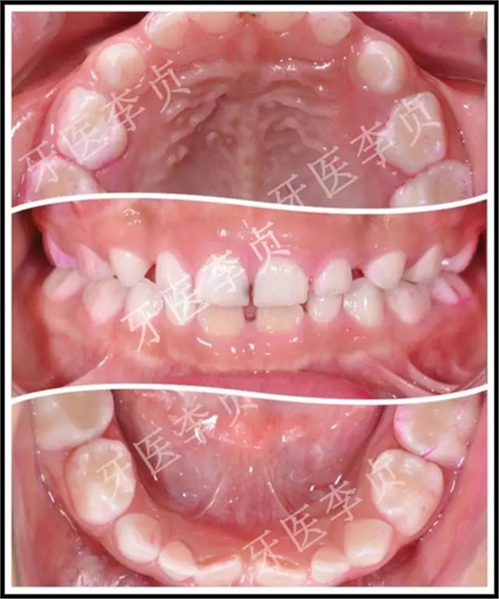 兒牙病例|兒童蛀牙的修復 兒牙病例|兒童蛀牙的修復