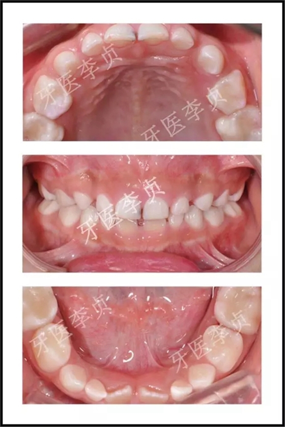 兒牙病例|兒童蛀牙的修復 兒牙病例|兒童蛀牙的修復