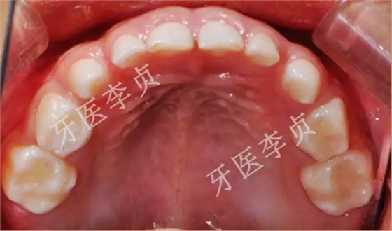 兒牙病例|兒童蛀牙的修復 兒牙病例|兒童蛀牙的修復