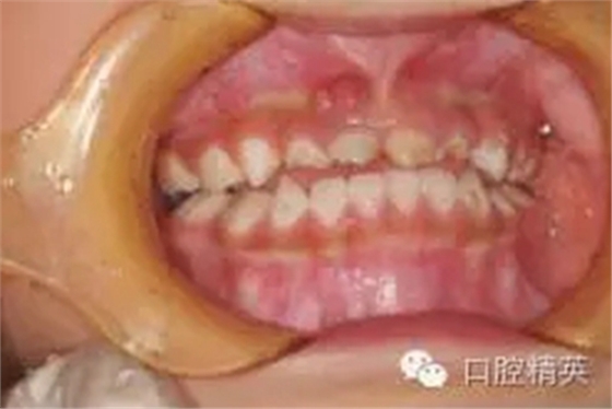 全麻下兒科治療+兒牙樹脂充填 全麻下兒科治療+兒牙樹脂充填