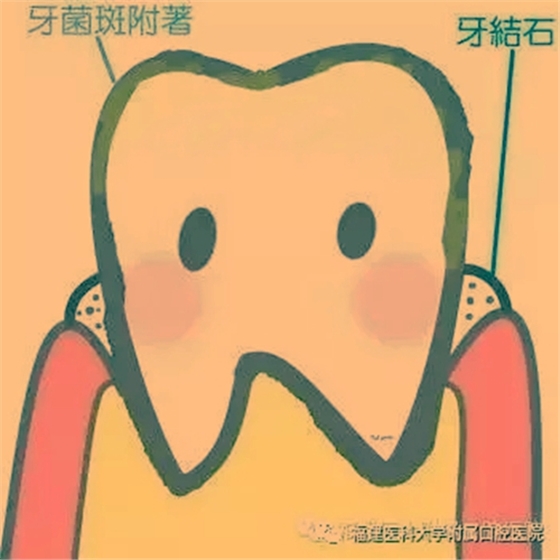 牙結(jié)石是怎么從一個 牙結(jié)石是怎么從一個
