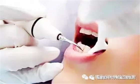 牙結(jié)石是怎么從一個 牙結(jié)石是怎么從一個