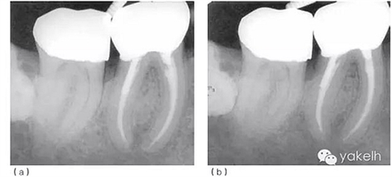 根管治療后根尖周炎(繼發(fā)感染) 根管治療后根尖周炎(繼發(fā)感染)