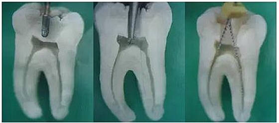 根管治療圖譜 根管治療圖譜