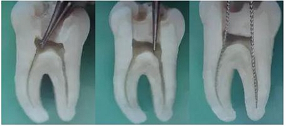 根管治療圖譜 根管治療圖譜