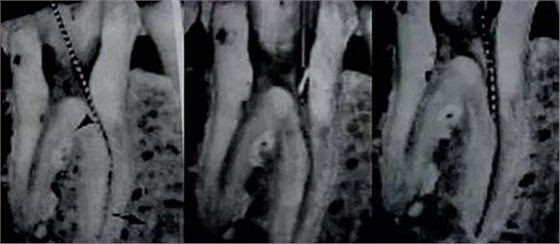 根管治療圖譜 根管治療圖譜