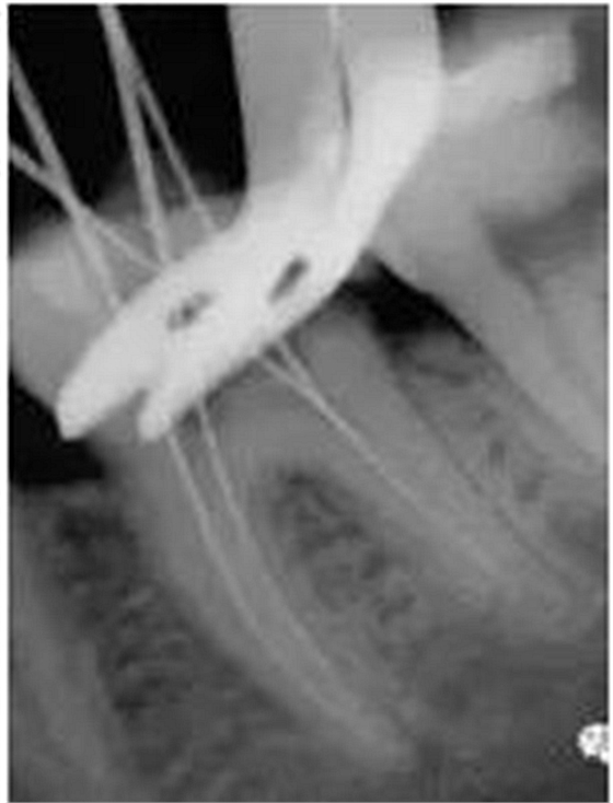 根管治療圖譜 根管治療圖譜