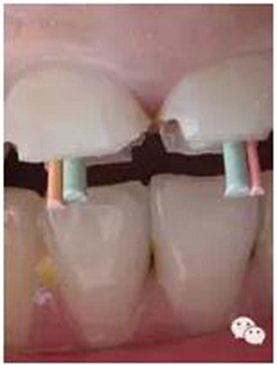 根管治療圖譜 根管治療圖譜