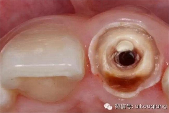 根管側(cè)穿修補(bǔ)術(shù) 根管側(cè)穿修補(bǔ)術(shù)