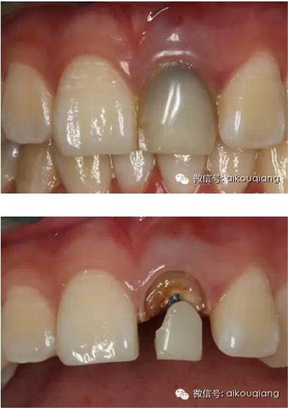 根管側(cè)穿修補(bǔ)術(shù) 根管側(cè)穿修補(bǔ)術(shù)