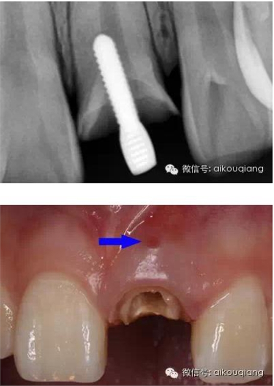 根管側(cè)穿修補(bǔ)術(shù) 根管側(cè)穿修補(bǔ)術(shù)