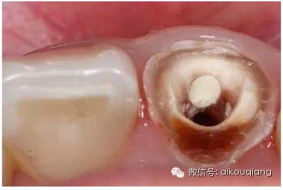 根管側(cè)穿修補(bǔ)術(shù) 根管側(cè)穿修補(bǔ)術(shù)