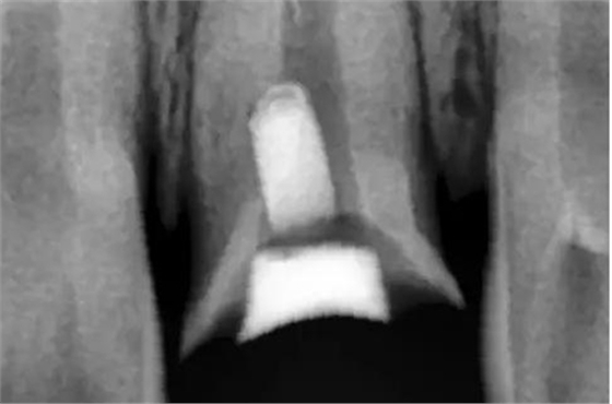 根管側(cè)穿修補(bǔ)術(shù) 根管側(cè)穿修補(bǔ)術(shù)