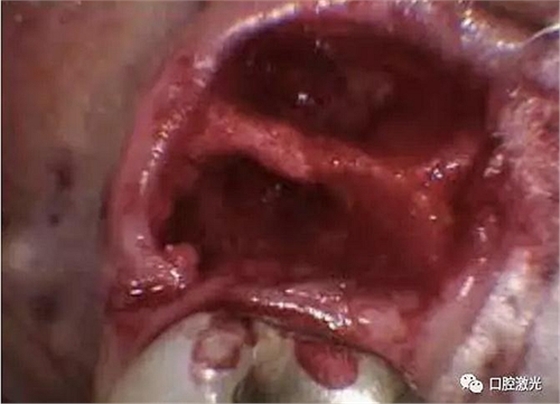 口腔激光在干槽癥中的應(yīng)用 口腔激光在干槽癥中的應(yīng)用