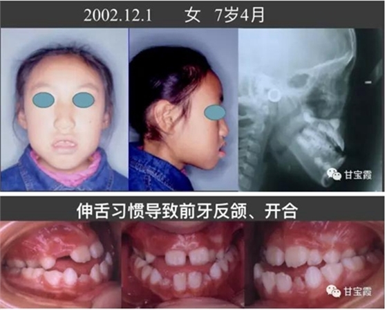 口腔不良習(xí)慣會(huì)引起牙頜畸形 口腔不良習(xí)慣會(huì)引起牙頜畸形