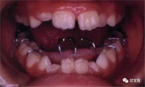 口腔不良習(xí)慣會(huì)引起牙頜畸形 口腔不良習(xí)慣會(huì)引起牙頜畸形