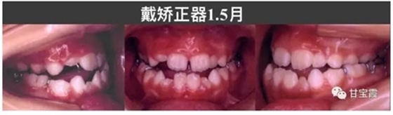 口腔不良習(xí)慣會(huì)引起牙頜畸形 口腔不良習(xí)慣會(huì)引起牙頜畸形