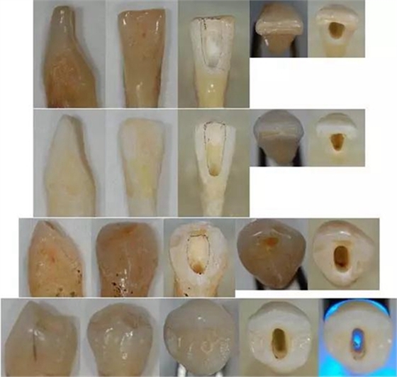 各牙齒的大概的開髓形態(tài) 各牙齒的大概的開髓形態(tài)
