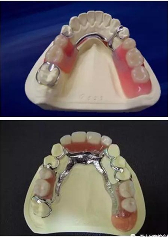 醫(yī)大口腔綜合科 |“鑲牙”的學(xué)問(wèn)——活動(dòng)類(lèi) 醫(yī)大口腔綜合科 |“鑲牙”的學(xué)問(wèn)——活動(dòng)類(lèi)