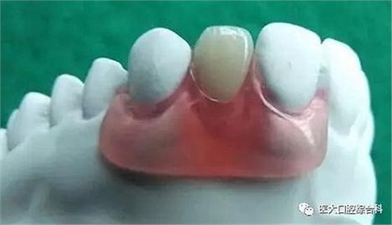 醫(yī)大口腔綜合科 |“鑲牙”的學(xué)問(wèn)——活動(dòng)類(lèi) 醫(yī)大口腔綜合科 |“鑲牙”的學(xué)問(wèn)——活動(dòng)類(lèi)