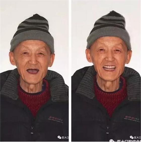 醫(yī)大口腔綜合科 |“鑲牙”的學(xué)問(wèn)——活動(dòng)類(lèi) 醫(yī)大口腔綜合科 |“鑲牙”的學(xué)問(wèn)——活動(dòng)類(lèi)