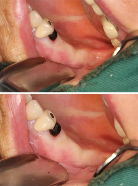 牙周病患者的外提升 牙周病患者的外提升