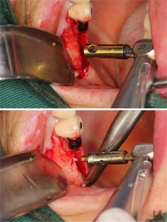 牙周病患者的外提升 牙周病患者的外提升