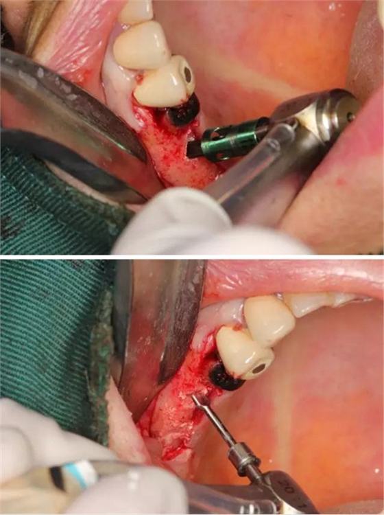 牙周病患者的外提升 牙周病患者的外提升