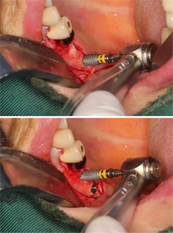 牙周病患者的外提升 牙周病患者的外提升
