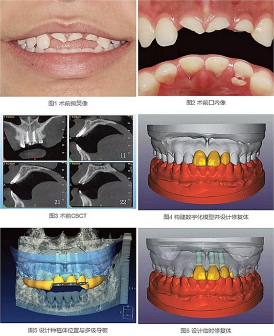 上頜多顆相鄰前牙的“精確化”即刻種植修復(fù) 上頜多顆相鄰前牙的“精確化”即刻種植修復(fù)