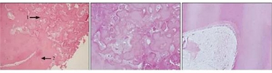 下頜骨骨化纖維瘤并發(fā)組合性牙瘤1例 下頜骨骨化纖維瘤并發(fā)組合性牙瘤1例