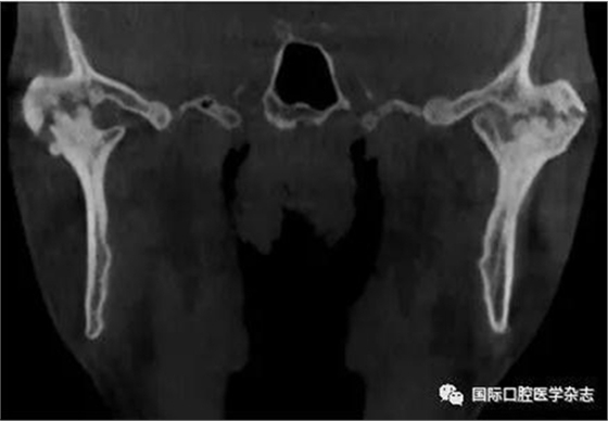 張清彬談張口受限 張清彬談張口受限