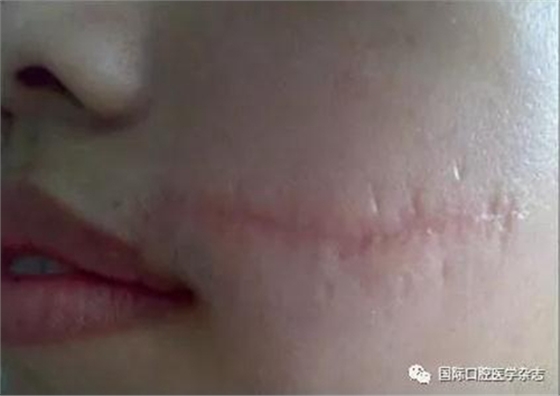 張清彬談張口受限 張清彬談張口受限