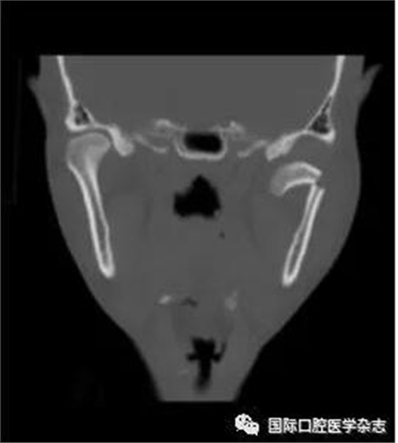 張清彬談張口受限 張清彬談張口受限