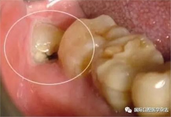 張清彬談張口受限 張清彬談張口受限