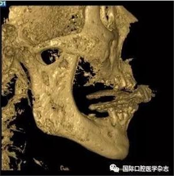 張清彬談張口受限 張清彬談張口受限