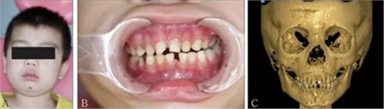 張清彬談張口受限 張清彬談張口受限