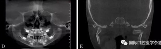 張清彬談張口受限 張清彬談張口受限