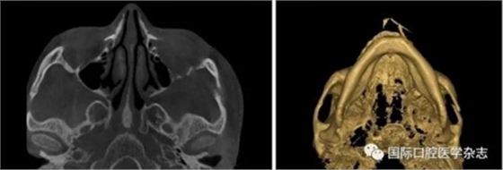 張清彬談張口受限 張清彬談張口受限