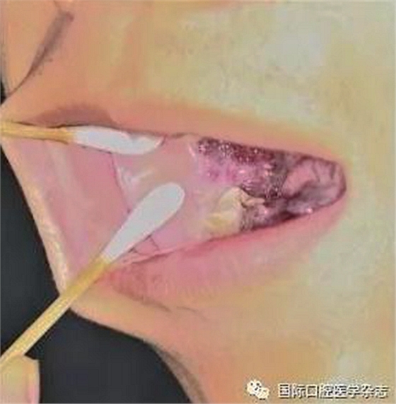 張清彬談張口受限 張清彬談張口受限