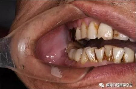 張清彬談張口受限 張清彬談張口受限