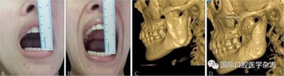 張清彬談張口受限 張清彬談張口受限