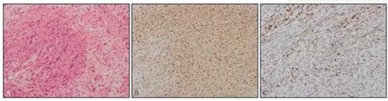 下頜反復(fù)溢膿，是何原因？  