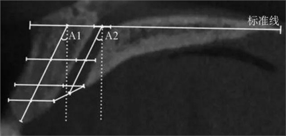 正常人群上頜前牙區(qū)鼻腭管相關(guān)解剖結(jié)構(gòu)的錐形束CT研究 正常人群上頜前牙區(qū)鼻腭管相關(guān)解剖結(jié)構(gòu)的錐形束CT研究