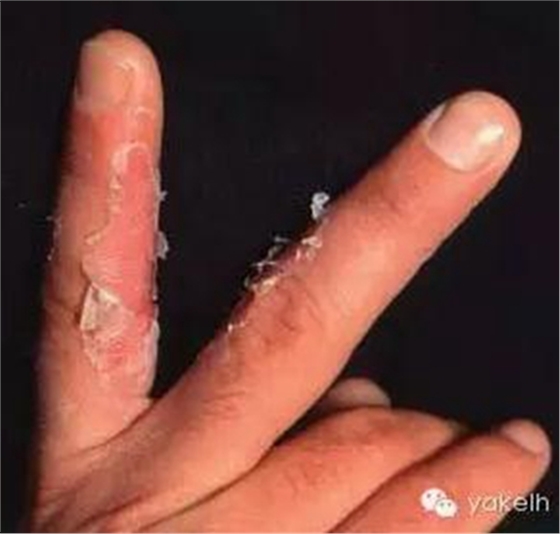 正畸中與材料相關(guān)的副作用---樹(shù)脂基材料的過(guò)敏反應(yīng) 正畸中與材料相關(guān)的副作用---樹(shù)脂基材料的過(guò)敏反應(yīng)