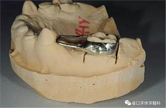 【牙醫(yī)學(xué)堂】間隙保持器的介紹 【牙醫(yī)學(xué)堂】間隙保持器的介紹
