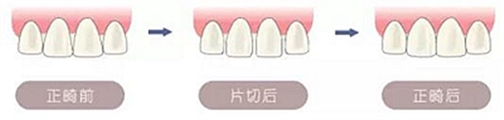 醫(yī)生方案里的鄰面去釉，究竟是什么？