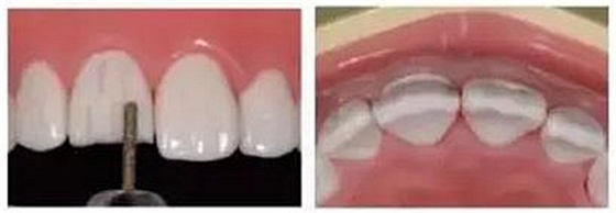 前牙全瓷冠牙體預(yù)備步驟 前牙全瓷冠牙體預(yù)備步驟