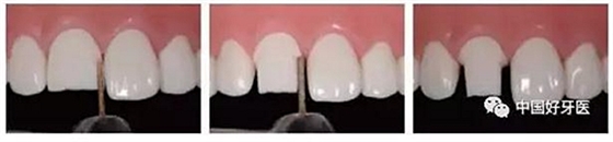 前牙全瓷冠牙體預(yù)備步驟 前牙全瓷冠牙體預(yù)備步驟