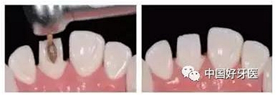 前牙全瓷冠牙體預(yù)備步驟 前牙全瓷冠牙體預(yù)備步驟
